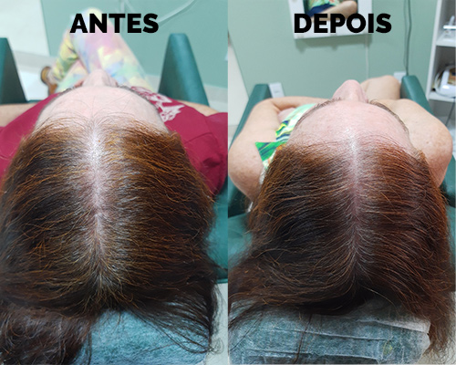 Calvície feminina, 9 meses 