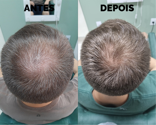 Calvície masculina 12 meses de tratamento