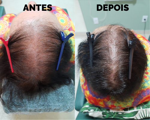 Alopecia senil antes e depois 4 meses de tratamento
